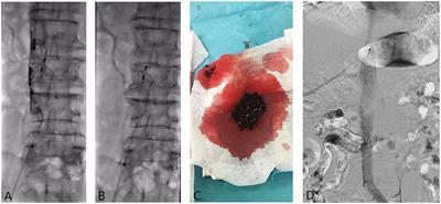 AngioJet Rheolytic Thrombectomy to Treat Inferior Vena Cava Filter-Related Thrombosis: Efficacy and Safety Compared With Large-Lumen Catheter Suction